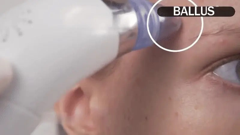 Electric Pore Cleaner & Facial Vacuum